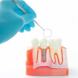 Mejores Dentistas En Mexico Para Implantes Dentales