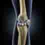 Knee Replacement in Turkey - Cost & Clinics