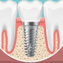 Affordable Dental Implants in Costa Rica - Save Up To 60%