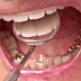 Root Canal and Crown in Mexico - Cost & Clinics