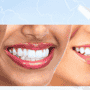 Tips to Find the Best Bone Graft Procedure in San Jose, Costa Rica