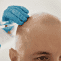 Best Countries for Hair Transplant Surgery in 2025