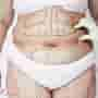 Affordable Liposuction in Thailand: Slim Down Without Breaking the Bank