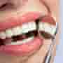 Porcelain Veneers in Costa Rica - Best Prices