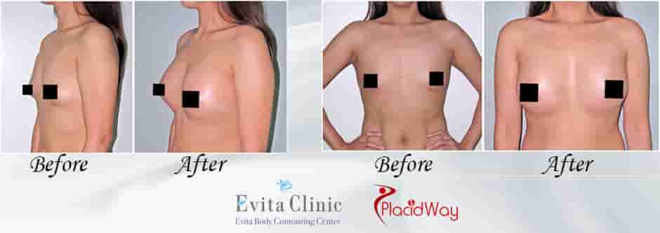 Breast Augmentation: Complete Guide & Information