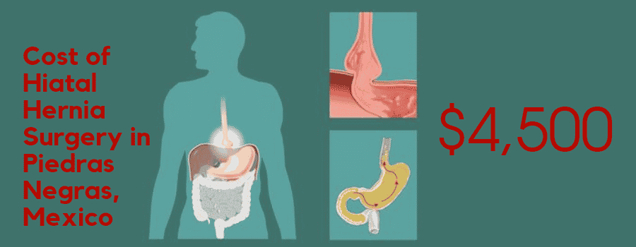 Hiatal Hernia Surgery Treatment in Piedras Negras, Mexico