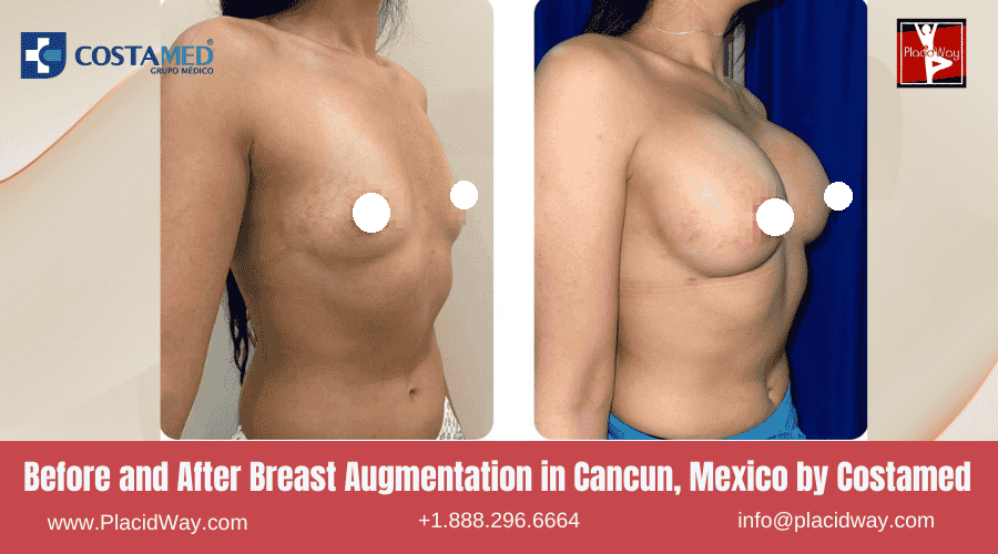 Low Cost Breast Implant Package in Cancun Mexico