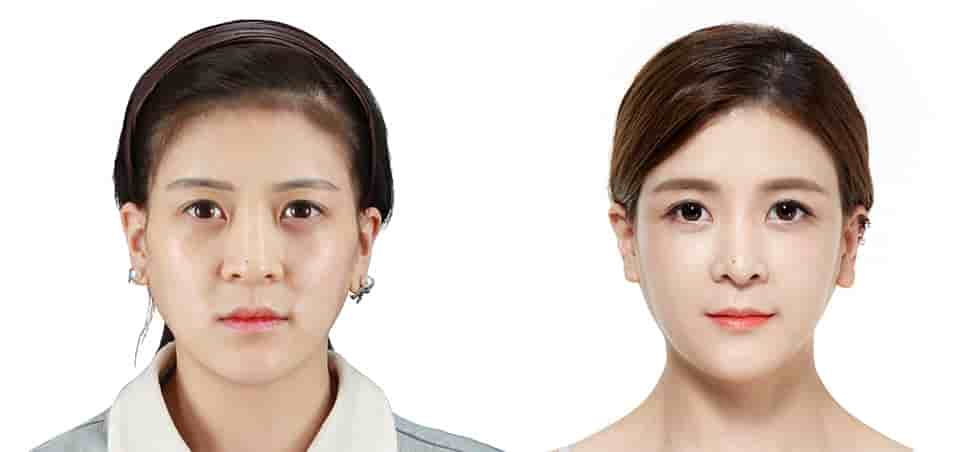 JK Plastic Surgery Clinic in Seoul, South Korea Reviews from Real Patients Slider image 2