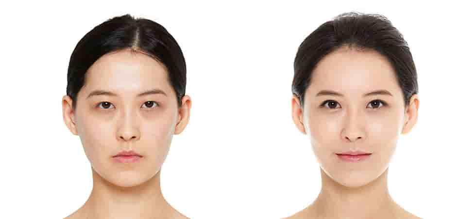 JK Plastic Surgery Clinic in Seoul, South Korea Reviews from Real Patients Slider image 3