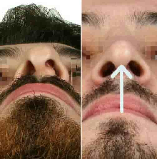 The Nose Aesthetic Clinic Reviews in Istanbul, Turkey Slider image 5