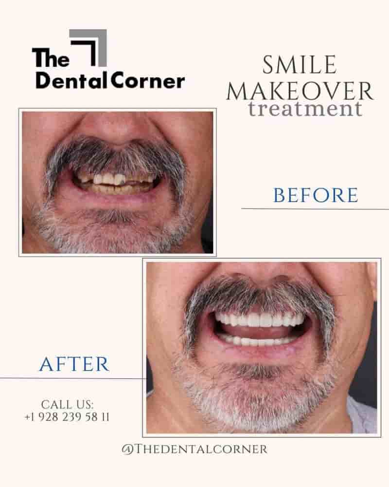 The Dental Corner in Los Algodones,Mexicali, Mexico Reviews from Real Patients Slider image 10