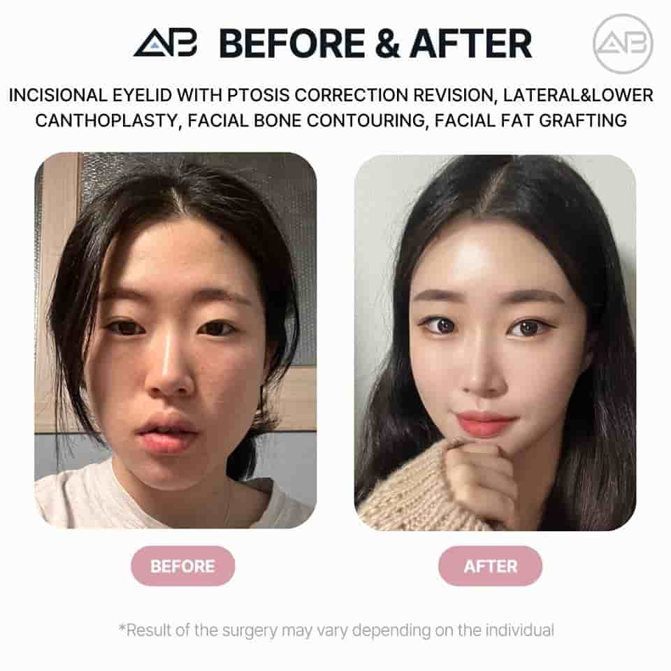 AB Plastic Surgery in Seoul, South Korea Reviews from Real Patients Slider image 5