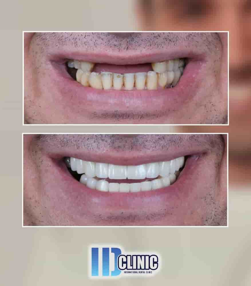 IDC International Dental Clinic in Antalya, Turkey Reviews from Real Patients Slider image 1