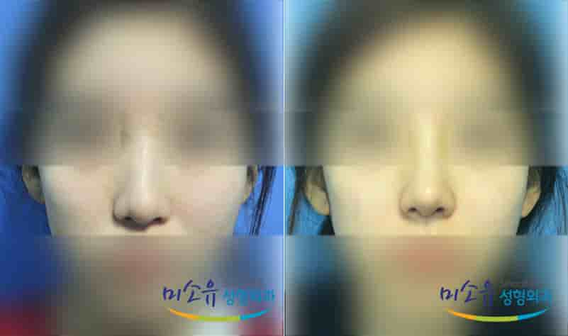 MISOU Plastic Surgery in Seoul, South Korea Reviews from Real Patients Slider image 3