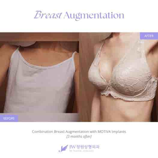 JW Plastic Surgery Korea Review - Cosmetic Surgery Seoul South Korea Slider image 4