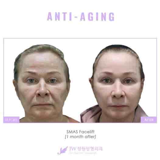 JW Plastic Surgery Korea Review - Cosmetic Surgery Seoul South Korea Slider image 6