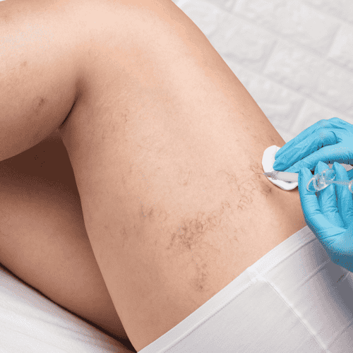 Permanent Spider Vein Removal  in Costa Rica