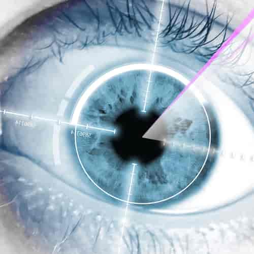 Cataract Femtosecond Laser Surgery at Villa Donatello Italy