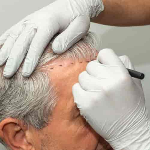 Best FUE Hair Transplant Package in Istanbul Turkey