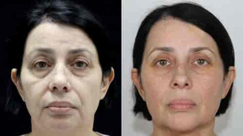 Non surgical  face anti-aging 