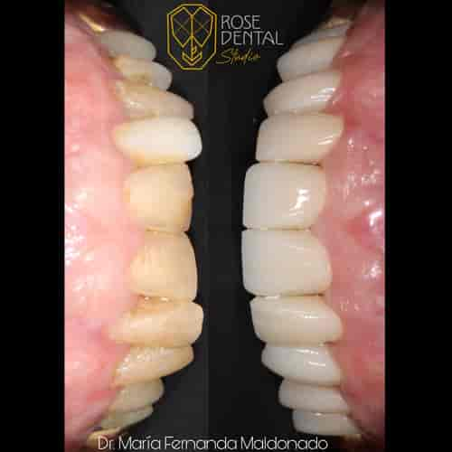 Dental Zirconium Crowns Package at Rose Dental Studio, Los Algodones, Mexico