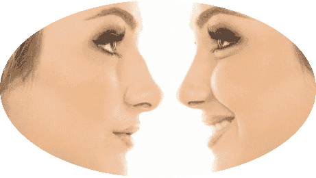 Nose Surgery Rhinoplasty Package at Cuba 