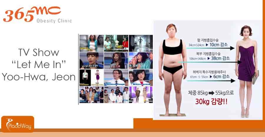 Thigh Liposuction Korea: Obesity Fatness Recovery, Cost and Benefits -  365mc Hospital