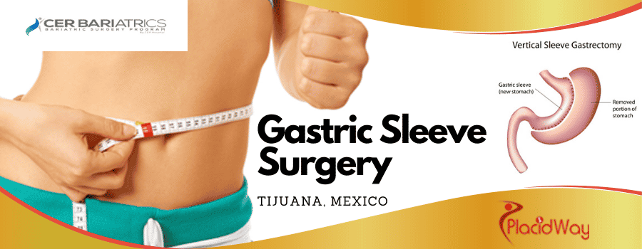 Gastric Sleeve in Tijuana Mexico in CER Hospital