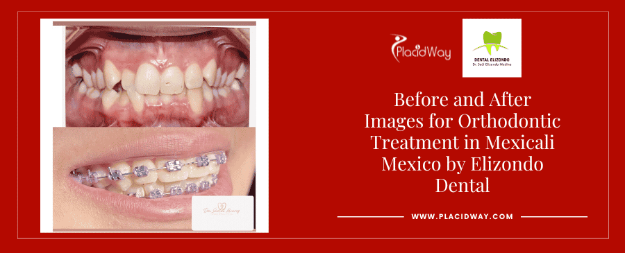 Dental Resin Fillings in Tijuana, Mexico - The Dental District