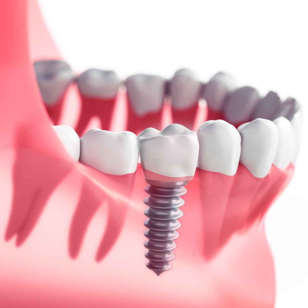 Dental Implants