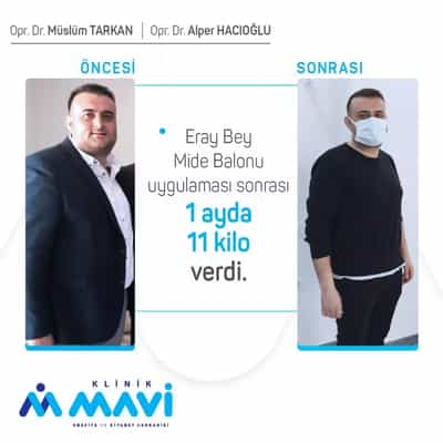 gastric sleeve in antalya turkey