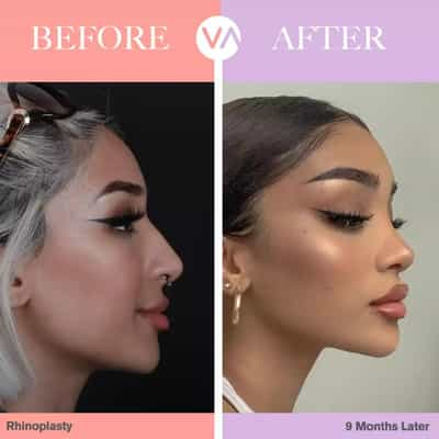 rhinoplasty in istanbul turkey