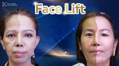 facelift bangkok thailand