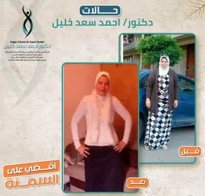 Premier Bariatric Surgery in Alexandria, Egypt