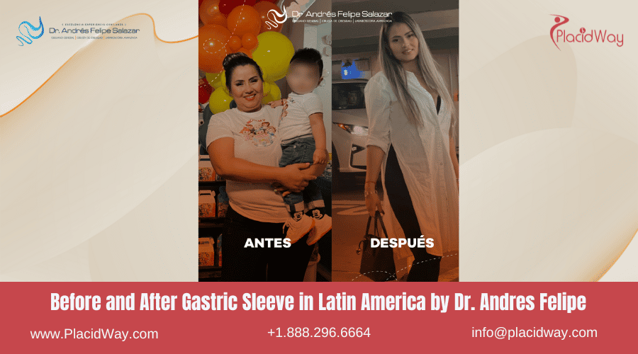 Gastric Sleeve in Latin America Before and After Images - Dr Andres Felipe