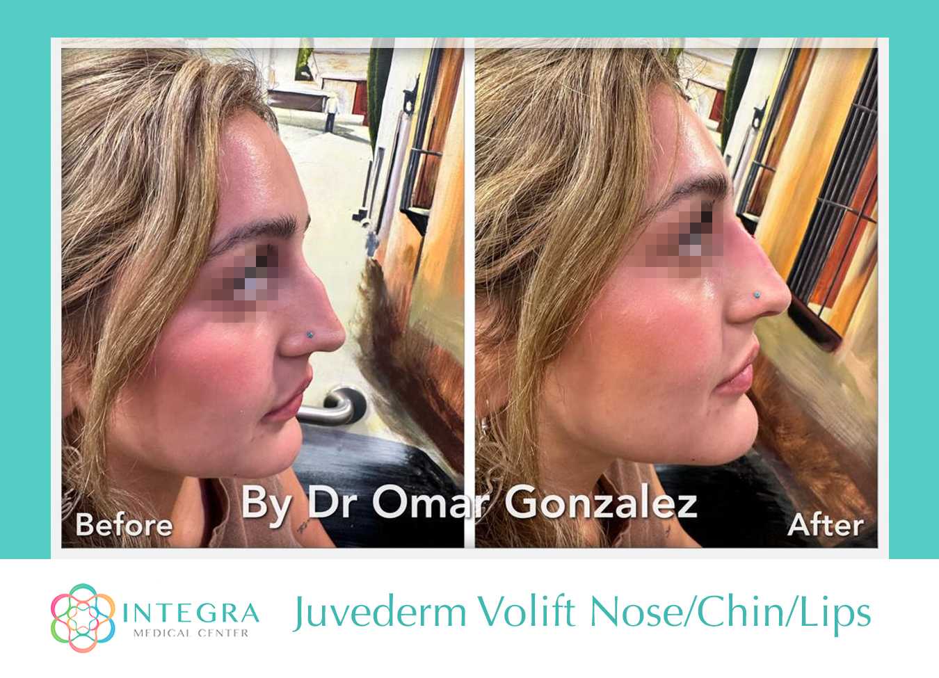 Before After - Juvederm Volift Application on Nose-Chin-Lips By Dr. Omar Gonzalez at Integra Medical Center in Nuevo Progreso, Mexico