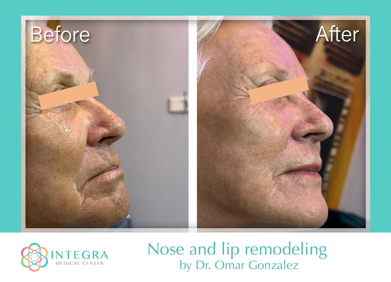 Before After - Nose and Lip Remodeling at Integra Medical Center in Nuevo Progreso, Mexico