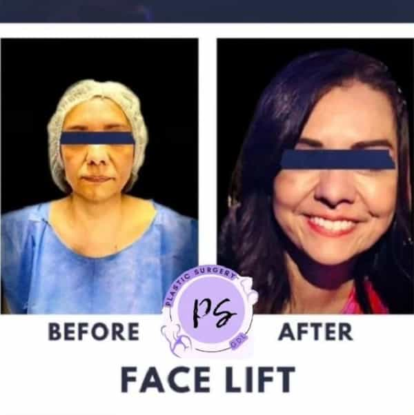 Imagen de antes y después de un lifting facial en Guadalajara, México