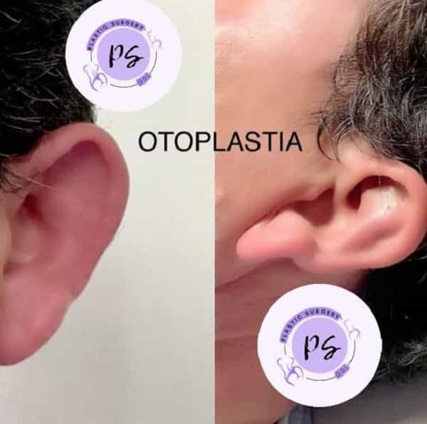 Imagen de antes y después de una otoplastia en Guadalajara, México