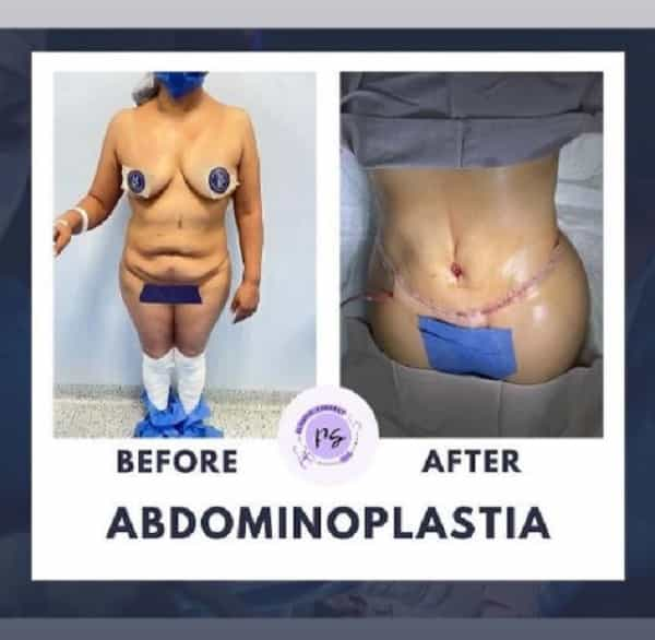 Imagen de antes y después de una abdominoplastia en Guadalajara, México