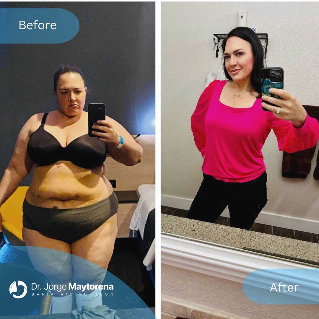 Before and After Image of Bariatric Surgery in Tijuana, Mexico