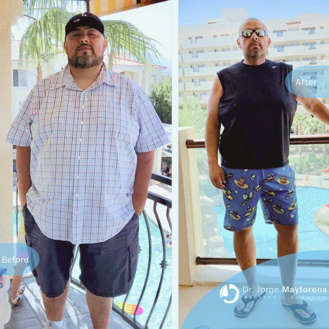 Before and After Image of Weight Loss Surgery in Tijuana, Mexico