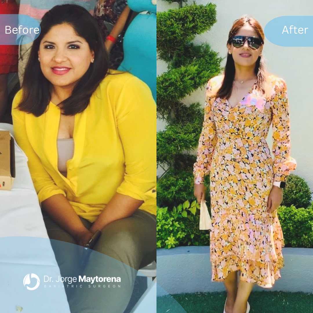 Before and After Image of Bariatric Surgery in Tijuana, Mexico