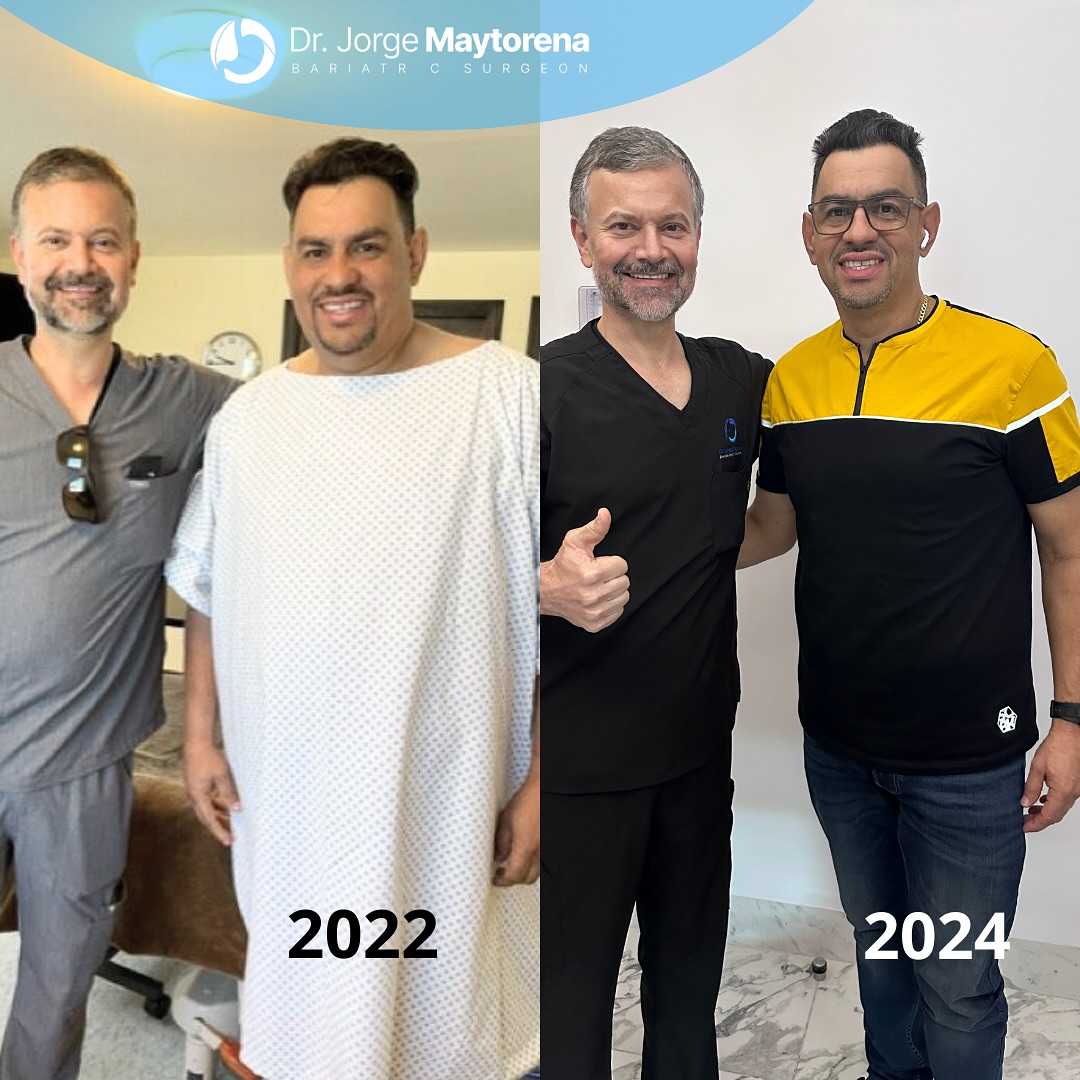 Before and After Image of Gastric Sleeve Surgery in Tijuana, Mexico