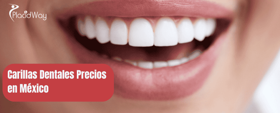 Carillas Dentales Precios en Mexico