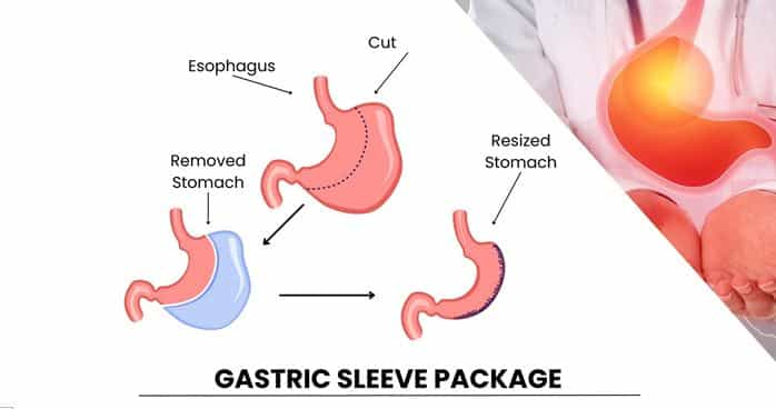 Gastric Sleeve Surgery Procedure