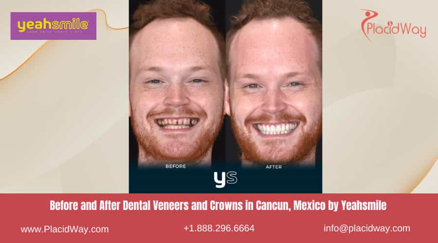 before and after dental veneers and crowns in cancun mexico