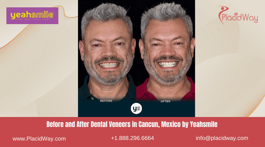 Before and After Dental Veneers in Cancun, Mexico by Yeahsmile 