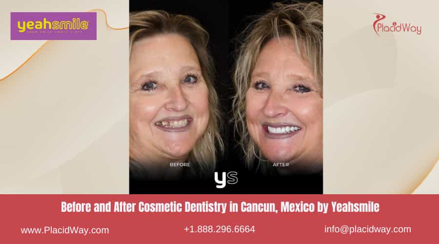 Before and After Cosmetic Dentistry in Cancun, Mexico by Yeahsmile
