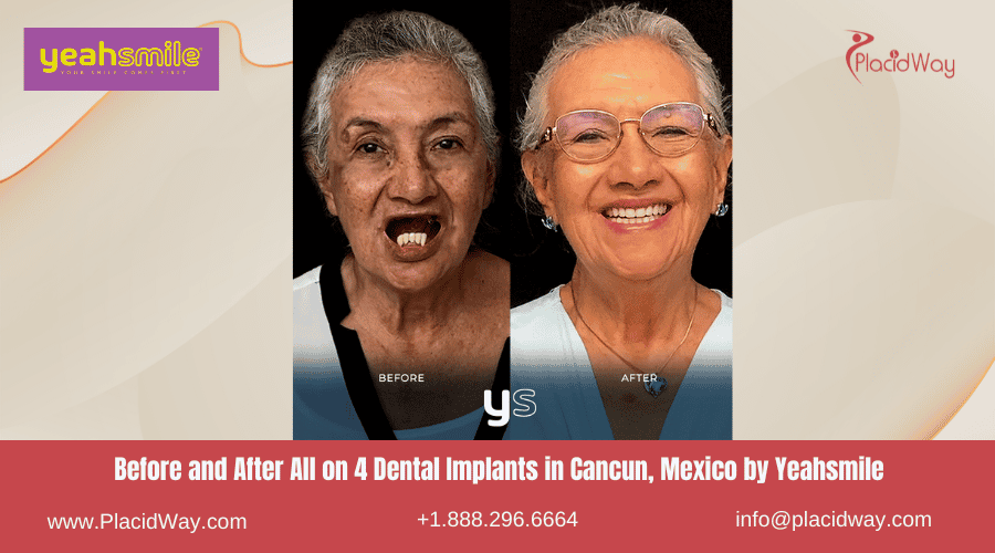 Before and After All on 4 Dental Implants in Cancun, Mexico by Yeahsmile
